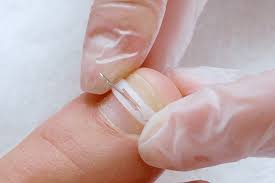Nagelspange Podofix*  *Klebespange
